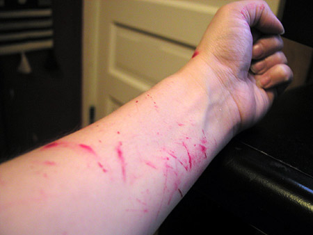 stained skin, pre-shower stained skin, pre-shower