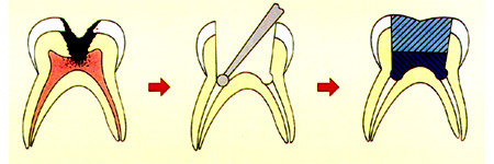 pulpotomy diagram